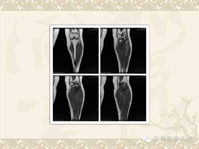 【病例】左胫骨骨肉瘤一例X线MR 【病例】左胫骨骨肉瘤一例X线MR