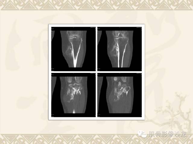 【病例】左胫骨骨肉瘤一例X线MR 【病例】左胫骨骨肉瘤一例X线MR