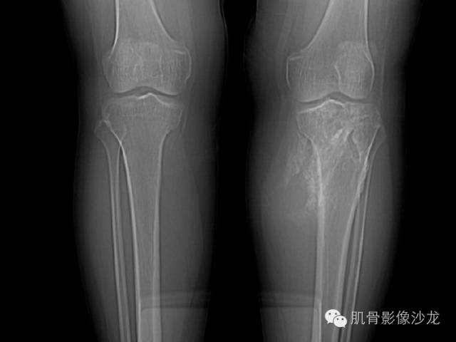 【病例】左胫骨骨肉瘤一例X线MR 【病例】左胫骨骨肉瘤一例X线MR
