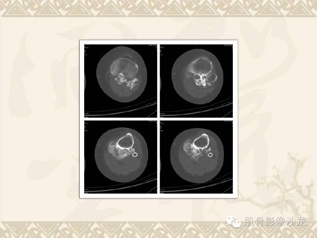 【病例】左胫骨骨肉瘤一例X线MR 【病例】左胫骨骨肉瘤一例X线MR