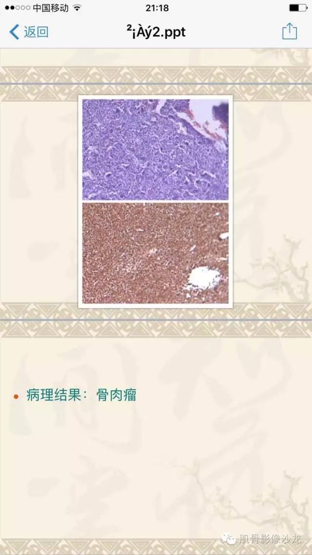 【病例】左胫骨骨肉瘤一例X线MR 【病例】左胫骨骨肉瘤一例X线MR