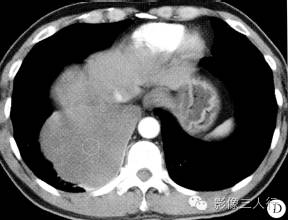 【病例】右侧胸膜孤立性纤维瘤1例CT影像表现 【病例】右侧胸膜孤立性纤维瘤1例CT影像表现