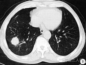 【病例】右下肺肉芽肿性炎变1例CT影像表现 【病例】右下肺肉芽肿性炎变1例CT影像表现