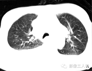 【病例】两肺淋巴瘤1例CT影像表现