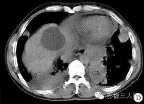 【病例】两肺淋巴瘤1例CT影像表现 【病例】两肺淋巴瘤1例CT影像表现