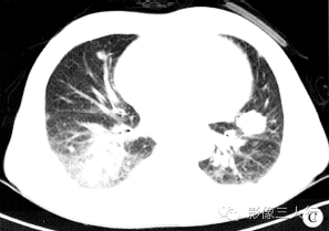 【病例】两肺淋巴瘤1例CT影像表现 【病例】两肺淋巴瘤1例CT影像表现