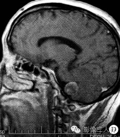 【病例】左椎动脉颅内段动脉瘤1例MR影像表现 【病例】左椎动脉颅内段动脉瘤1例MR影像表现