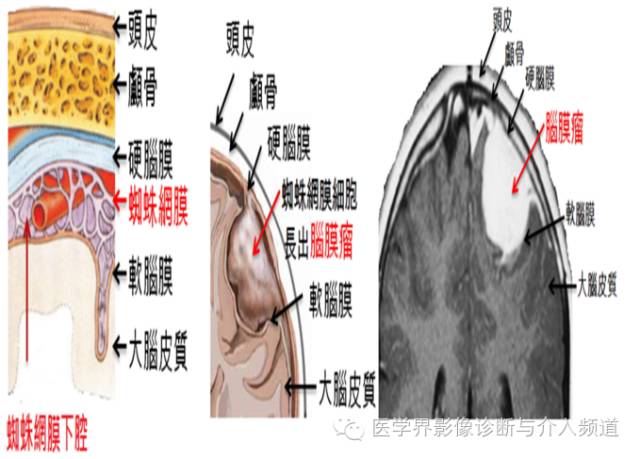 【病例】非典型脑膜瘤1例CT及MR影像表现