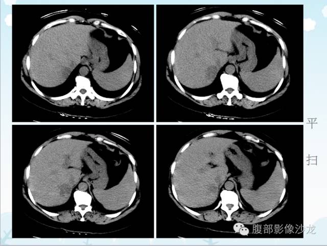 【病例】原发性肝癌1例CT影像表现 【病例】原发性肝癌1例CT影像表现