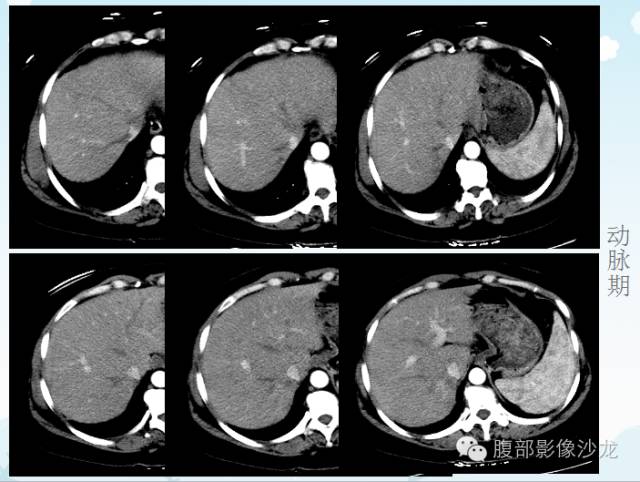 【病例】原发性肝癌1例CT影像表现 【病例】原发性肝癌1例CT影像表现