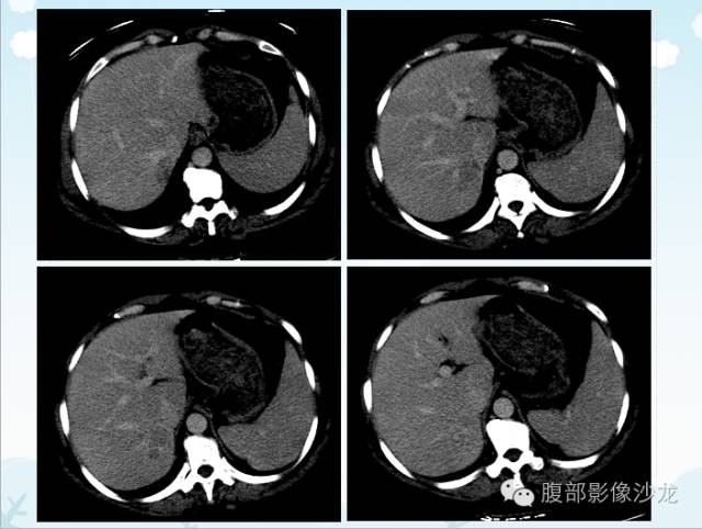 【病例】原发性肝癌1例CT影像表现 【病例】原发性肝癌1例CT影像表现