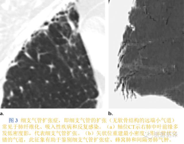 支气管扩张:相关常见及不常见疾病的机制及影像特征 支气管扩张:相关常见及不常见疾病的机制及影像特征