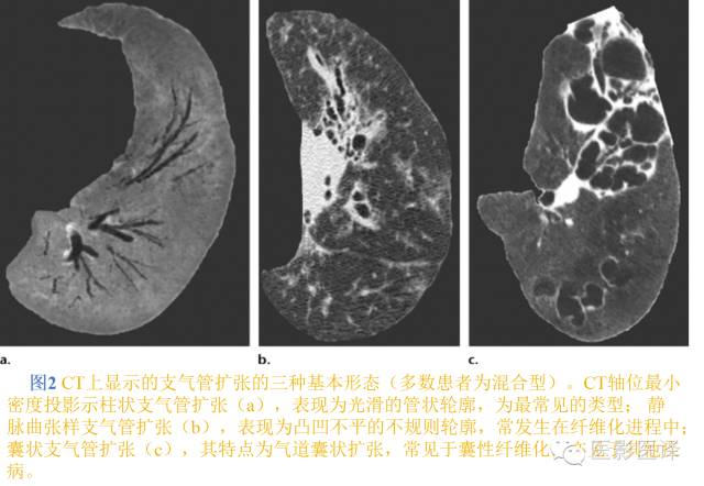 支气管扩张:相关常见及不常见疾病的机制及影像特征 支气管扩张:相关常见及不常见疾病的机制及影像特征