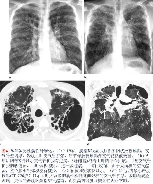 支气管扩张:相关常见及不常见疾病的机制及影像特征 支气管扩张:相关常见及不常见疾病的机制及影像特征