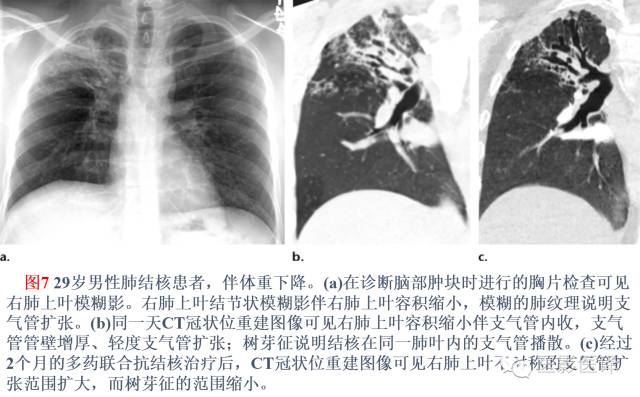 支气管扩张:相关常见及不常见疾病的机制及影像特征 支气管扩张:相关常见及不常见疾病的机制及影像特征