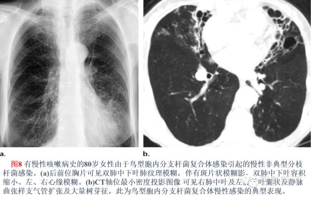 支气管扩张:相关常见及不常见疾病的机制及影像特征 支气管扩张:相关常见及不常见疾病的机制及影像特征