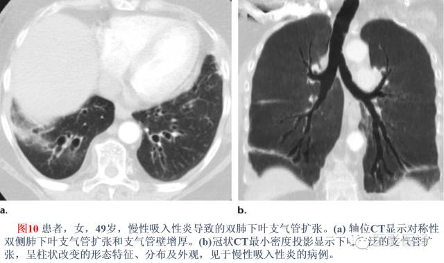 支气管扩张:相关常见及不常见疾病的机制及影像特征 支气管扩张:相关常见及不常见疾病的机制及影像特征