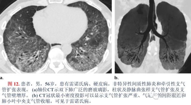 支气管扩张:相关常见及不常见疾病的机制及影像特征 支气管扩张:相关常见及不常见疾病的机制及影像特征