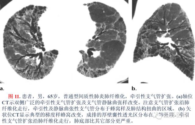 支气管扩张:相关常见及不常见疾病的机制及影像特征 支气管扩张:相关常见及不常见疾病的机制及影像特征