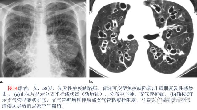 支气管扩张:相关常见及不常见疾病的机制及影像特征 支气管扩张:相关常见及不常见疾病的机制及影像特征