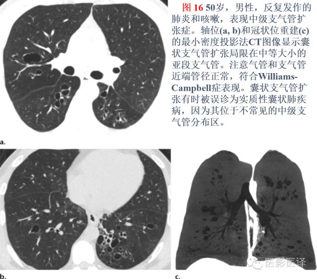 支气管扩张:相关常见及不常见疾病的机制及影像特征 支气管扩张:相关常见及不常见疾病的机制及影像特征