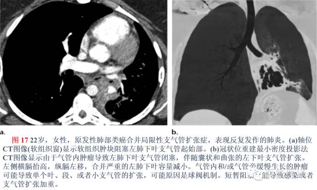 支气管扩张:相关常见及不常见疾病的机制及影像特征 支气管扩张:相关常见及不常见疾病的机制及影像特征