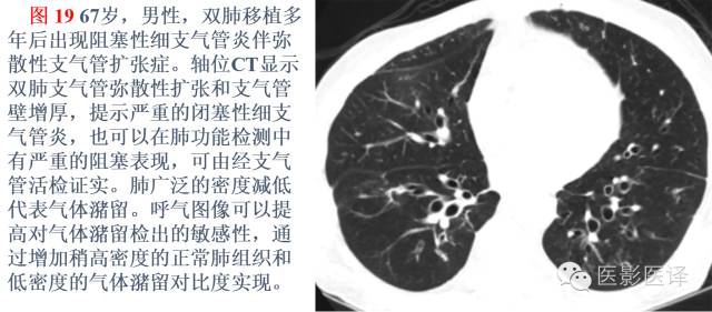 支气管扩张:相关常见及不常见疾病的机制及影像特征 支气管扩张:相关常见及不常见疾病的机制及影像特征