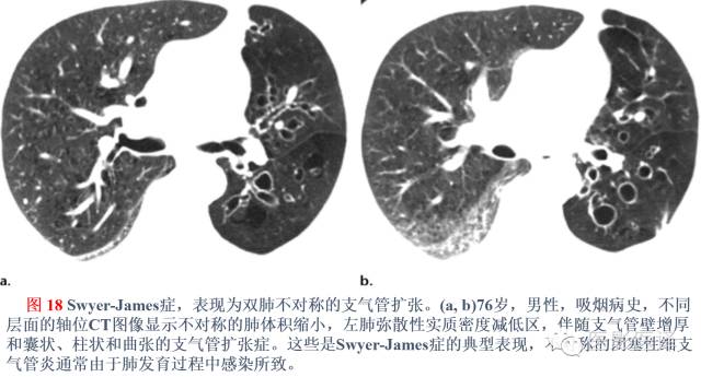支气管扩张:相关常见及不常见疾病的机制及影像特征 支气管扩张:相关常见及不常见疾病的机制及影像特征