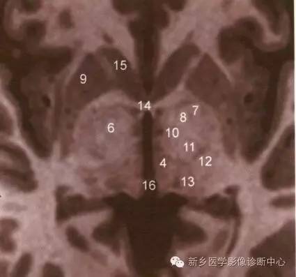 深刻了解丘脑解剖和血供 深刻了解丘脑解剖和血供