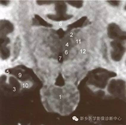 深刻了解丘脑解剖和血供 深刻了解丘脑解剖和血供