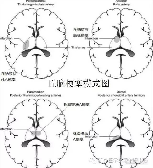 深刻了解丘脑解剖和血供 深刻了解丘脑解剖和血供