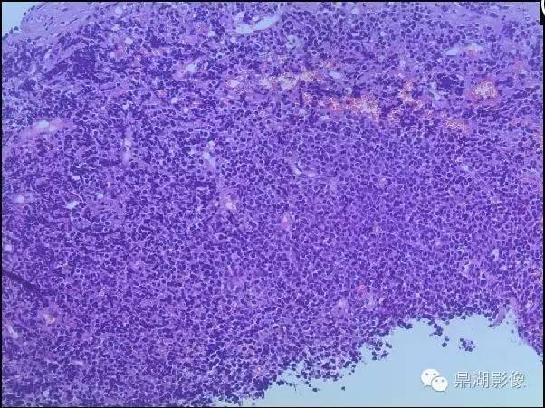 【病例】鼻咽淋巴瘤 1例CT影像表现
