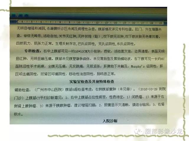 【病例】十二指肠间质瘤1例CT影像表现 【病例】十二指肠间质瘤1例CT影像表现