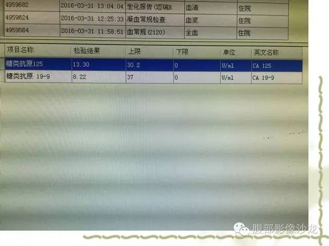 【病例】十二指肠间质瘤1例CT影像表现 【病例】十二指肠间质瘤1例CT影像表现