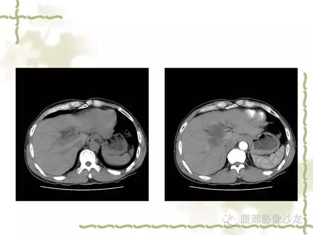 【病例】十二指肠间质瘤1例CT影像表现 【病例】十二指肠间质瘤1例CT影像表现