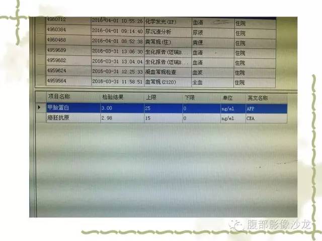 【病例】十二指肠间质瘤1例CT影像表现 【病例】十二指肠间质瘤1例CT影像表现