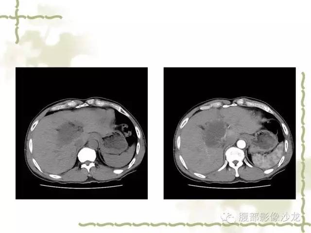 【病例】十二指肠间质瘤1例CT影像表现 【病例】十二指肠间质瘤1例CT影像表现