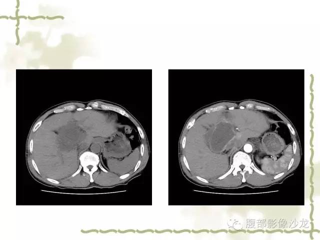 【病例】十二指肠间质瘤1例CT影像表现 【病例】十二指肠间质瘤1例CT影像表现