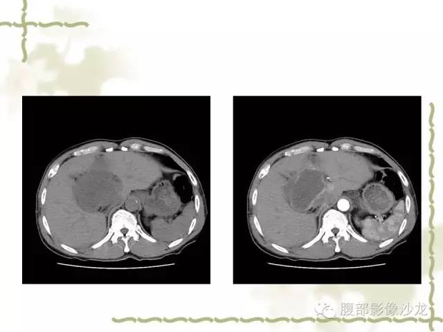 【病例】十二指肠间质瘤1例CT影像表现 【病例】十二指肠间质瘤1例CT影像表现