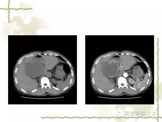 【病例】十二指肠间质瘤1例CT影像表现 【病例】十二指肠间质瘤1例CT影像表现