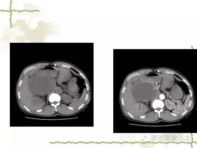 【病例】十二指肠间质瘤1例CT影像表现 【病例】十二指肠间质瘤1例CT影像表现