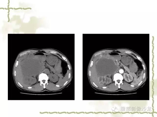 【病例】十二指肠间质瘤1例CT影像表现 【病例】十二指肠间质瘤1例CT影像表现