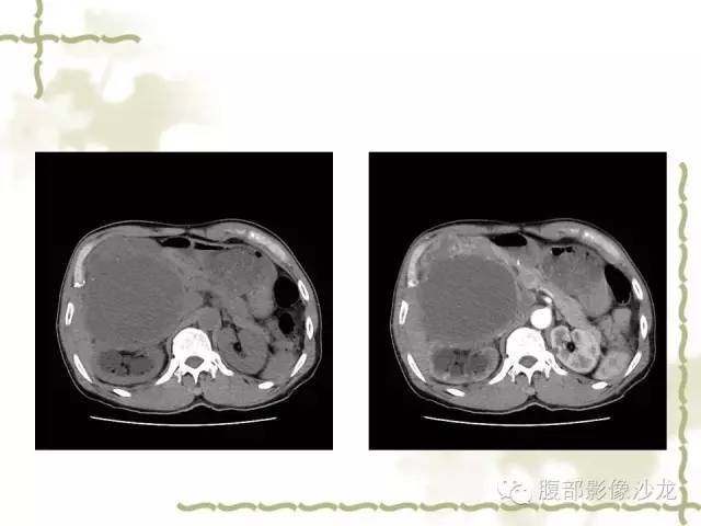 【病例】十二指肠间质瘤1例CT影像表现 【病例】十二指肠间质瘤1例CT影像表现