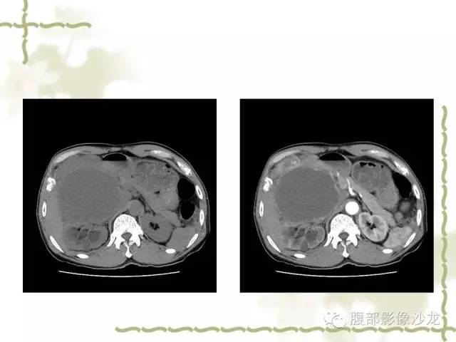 【病例】十二指肠间质瘤1例CT影像表现 【病例】十二指肠间质瘤1例CT影像表现