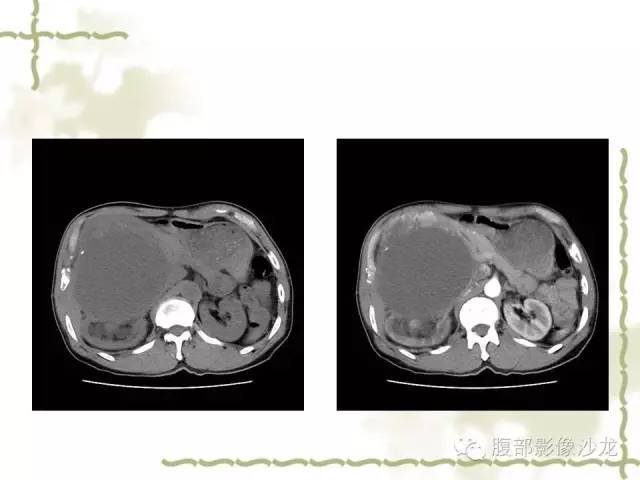 【病例】十二指肠间质瘤1例CT影像表现 【病例】十二指肠间质瘤1例CT影像表现