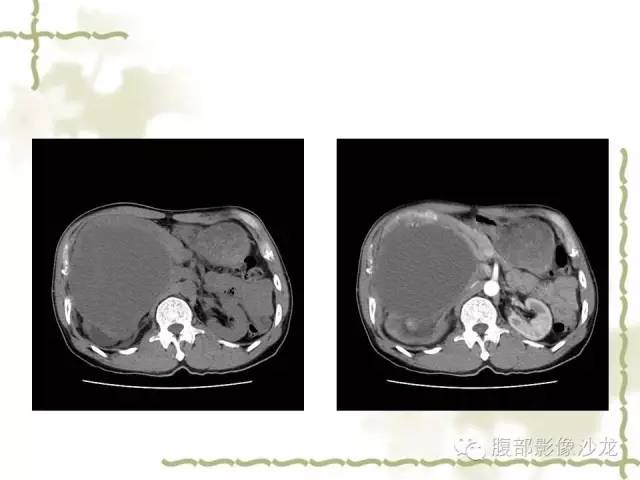 【病例】十二指肠间质瘤1例CT影像表现 【病例】十二指肠间质瘤1例CT影像表现