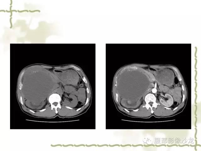 【病例】十二指肠间质瘤1例CT影像表现 【病例】十二指肠间质瘤1例CT影像表现