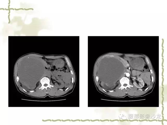 【病例】十二指肠间质瘤1例CT影像表现 【病例】十二指肠间质瘤1例CT影像表现