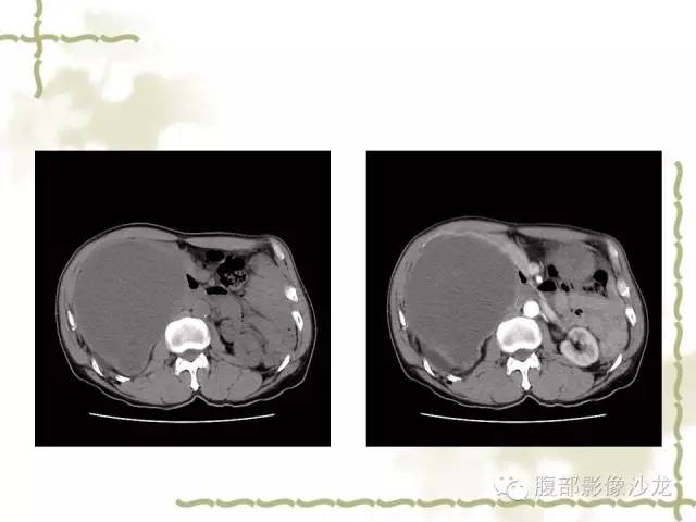 【病例】十二指肠间质瘤1例CT影像表现 【病例】十二指肠间质瘤1例CT影像表现