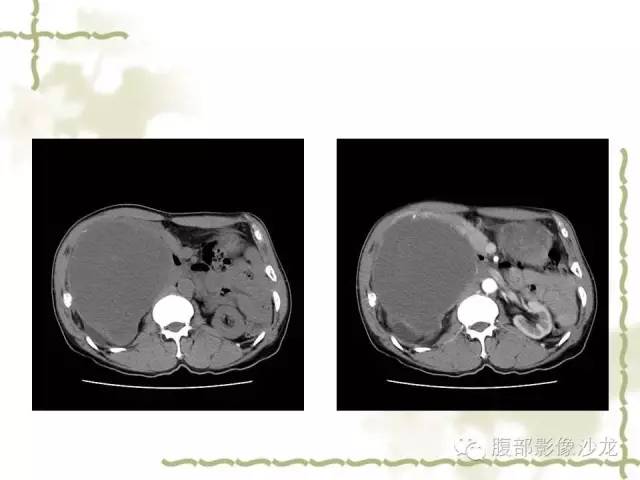 【病例】十二指肠间质瘤1例CT影像表现 【病例】十二指肠间质瘤1例CT影像表现